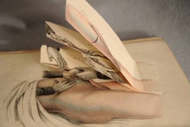 Diagram of a caesarean section, 1847